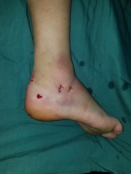 在当地医院,经过检查显示,刘先生双脚跟骨都出现了粉碎性骨折.